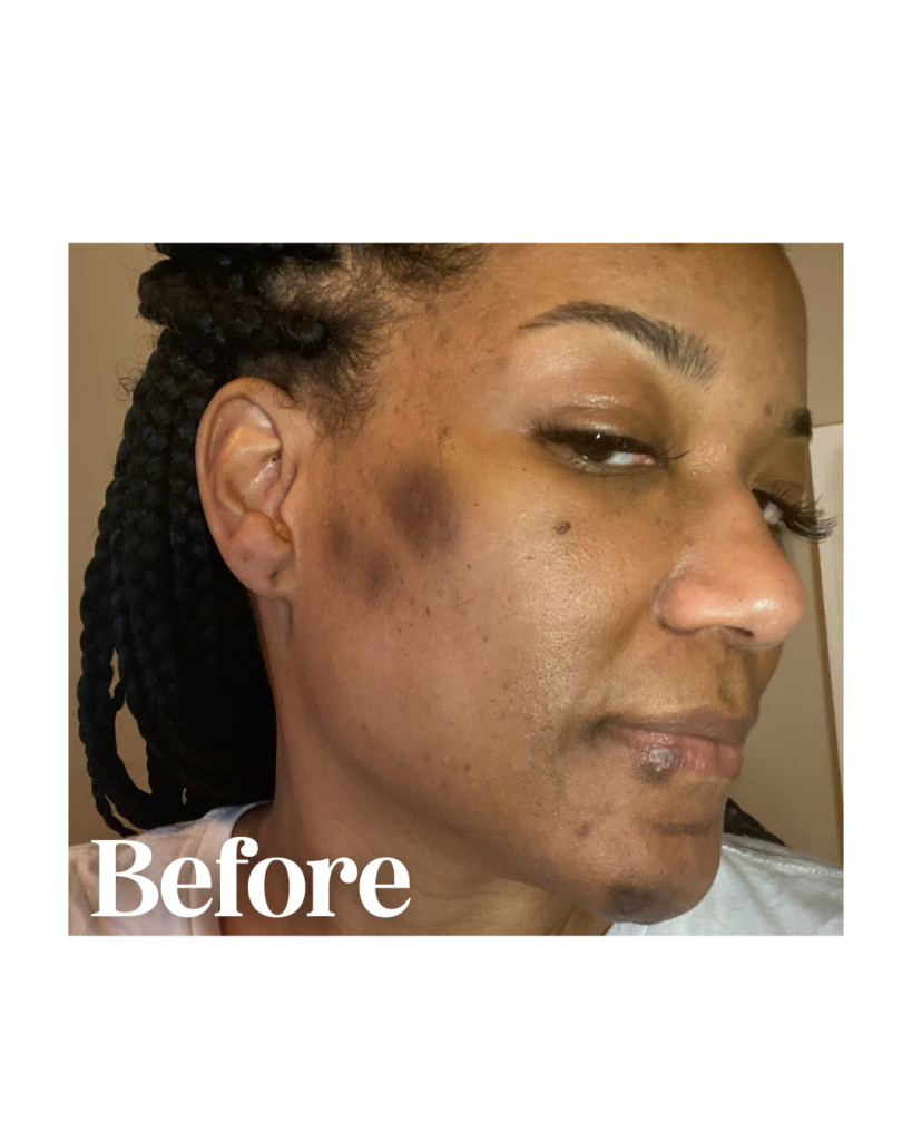 skincare over 40 acne scarring dark marks black woman before photo